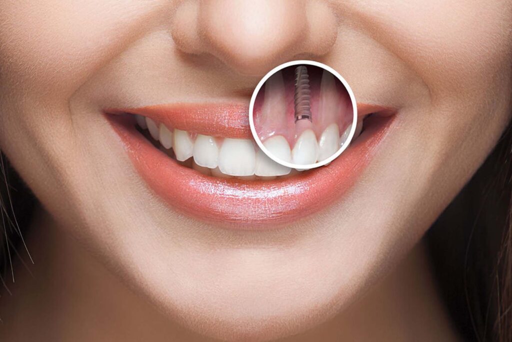 Dental Implants vs. Dentures: Which Is Right for You?