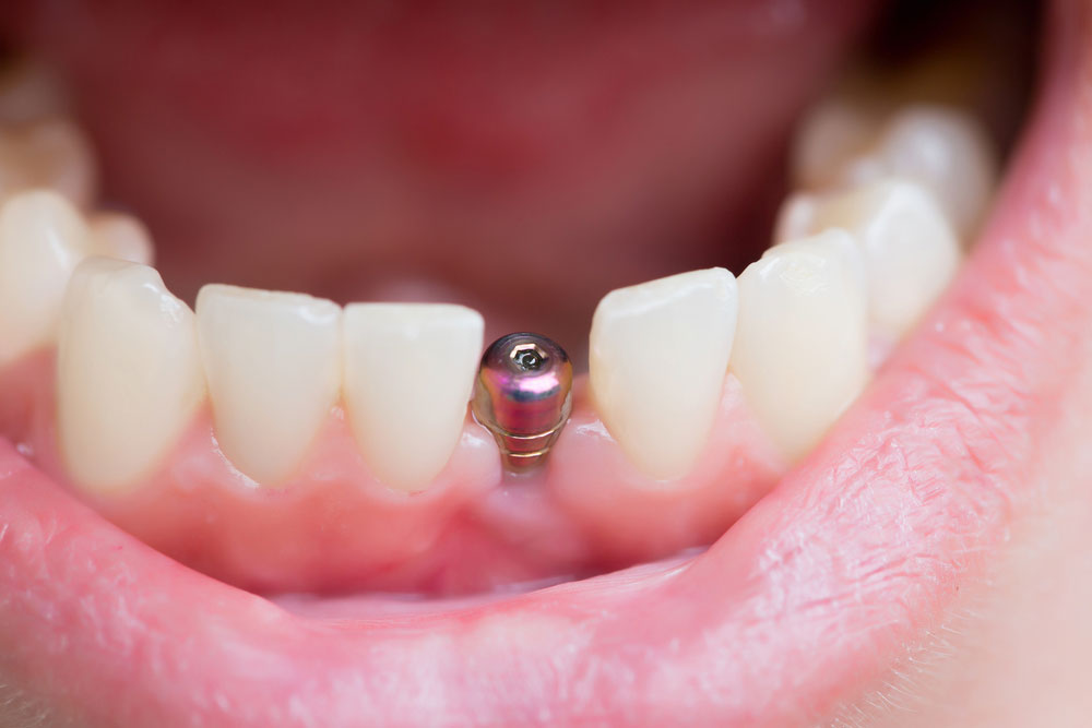 The Cost of Dental Implants: Is It Worth the Investment?